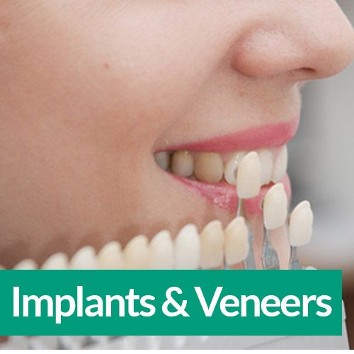 implants and veneers